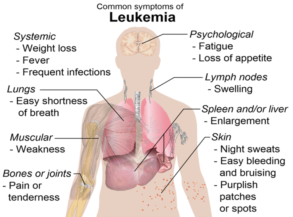 Leukemia its causes and types image