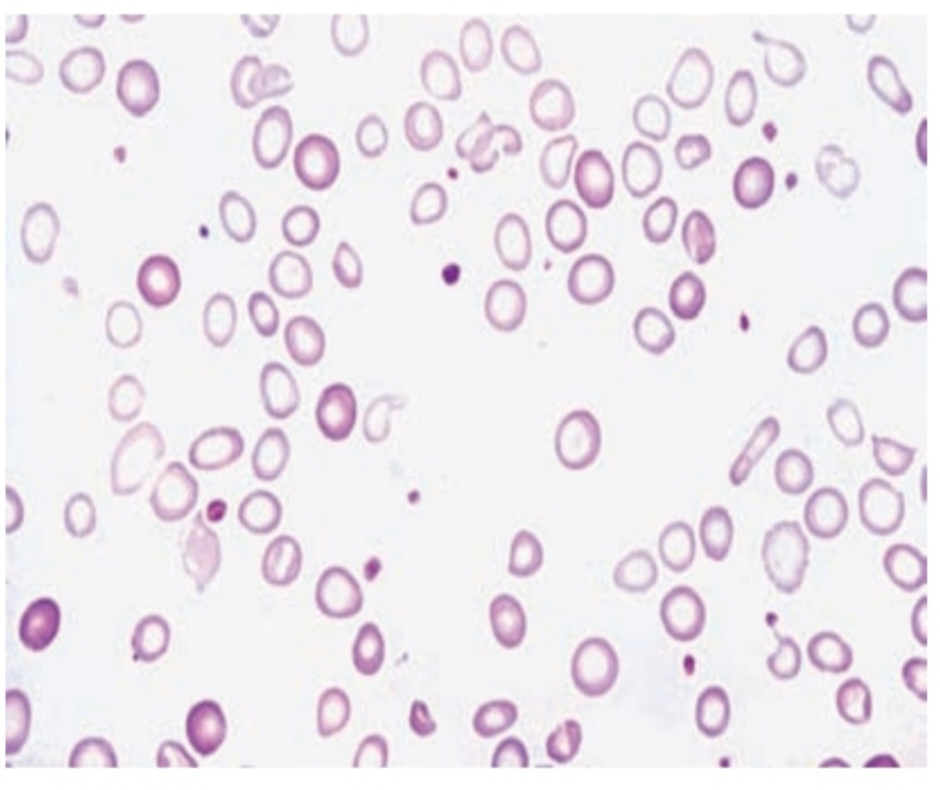Hypochromic Anemia causes and treatment image